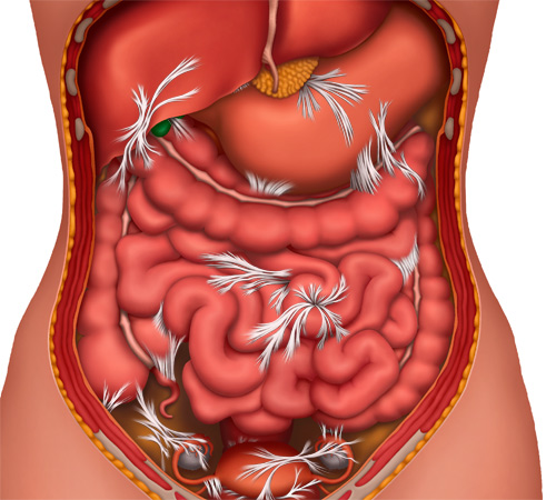 how visceral mobility can help remove adhesions in the gut
