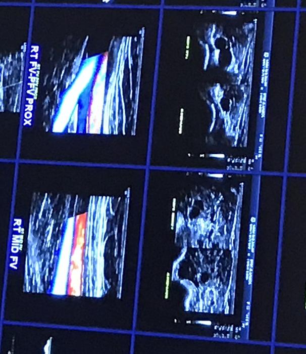 DVT in athletes