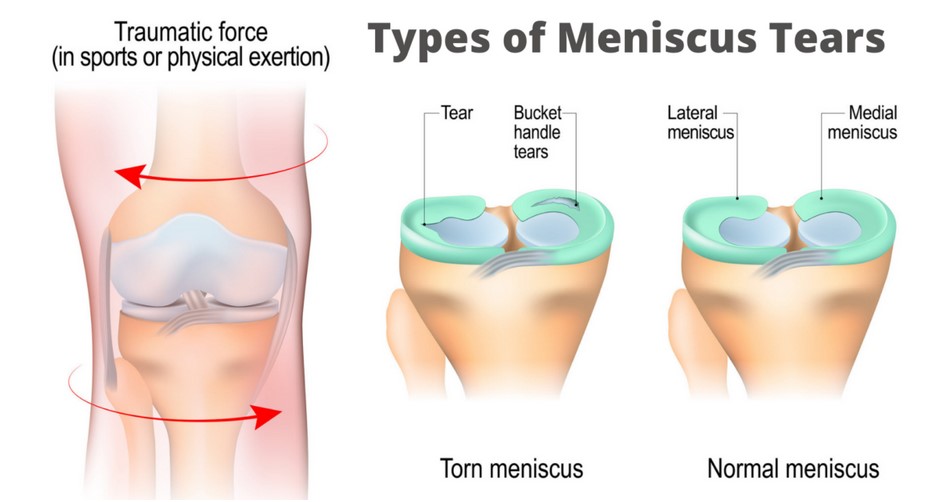 meniscus exercises