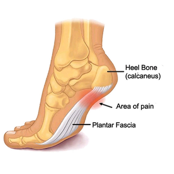 plantar fasciitis running