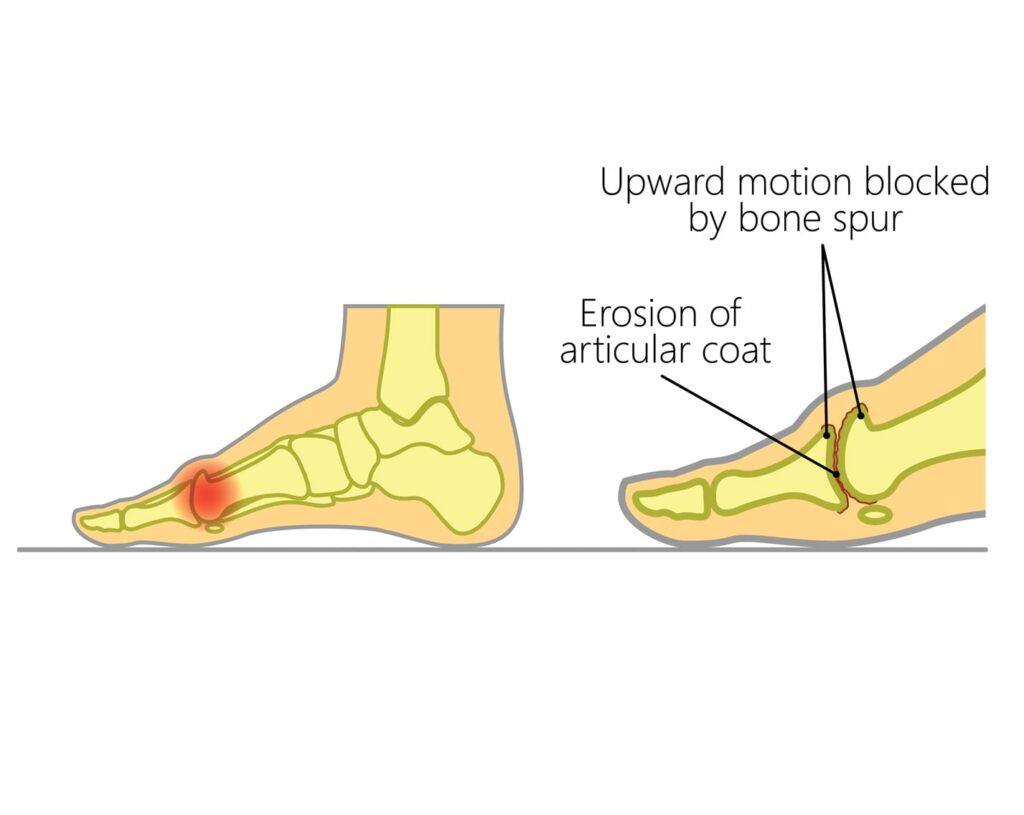 running foot pain causes