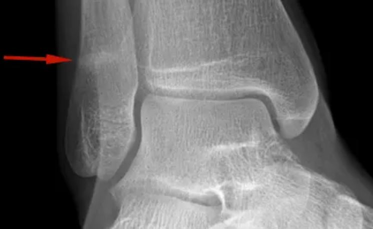 ankle stress fracture running