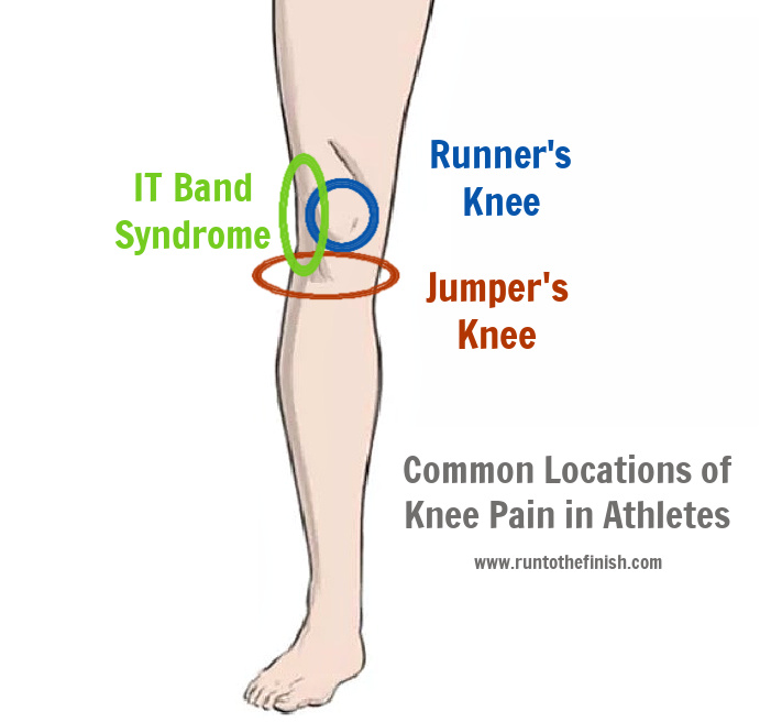 Runner's knee vs jumper's knee