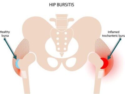 hip bursitis running