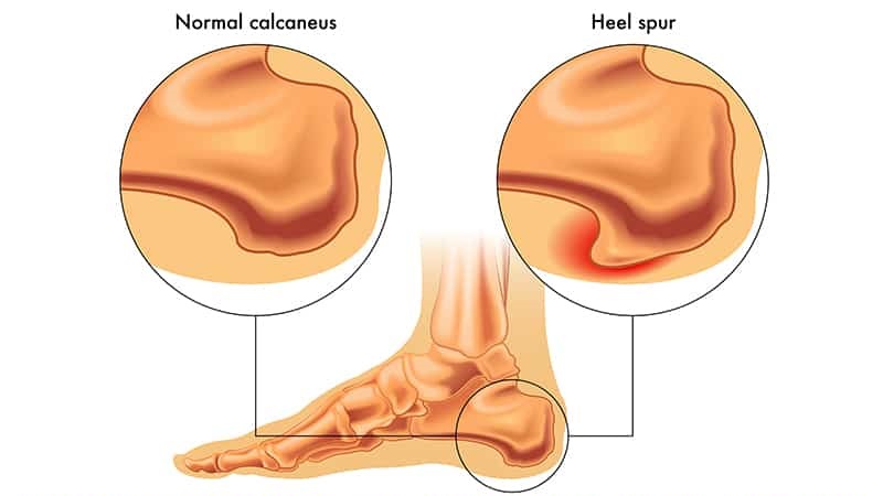 causes of heel pain from running